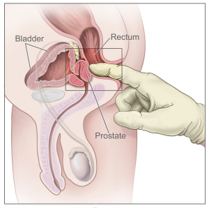 digital rectal exam